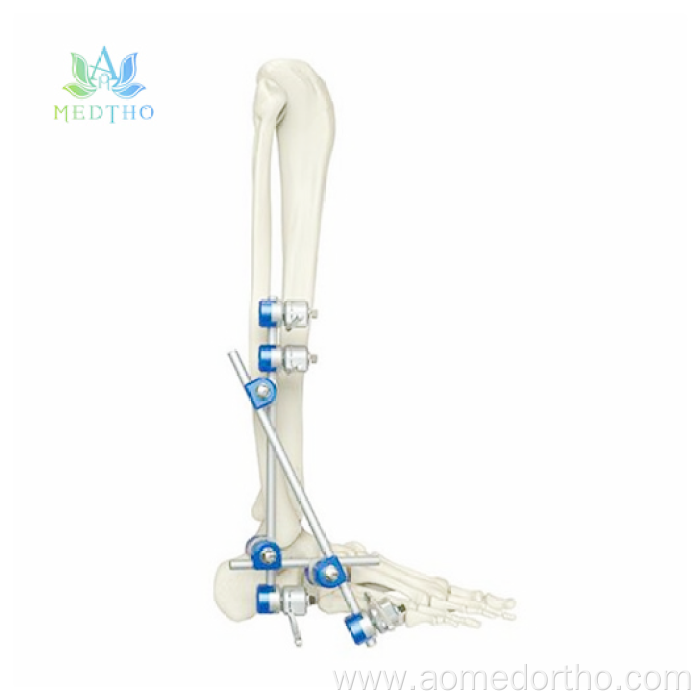 foot external fixator